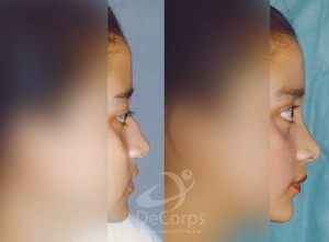 ClínicaDeCorps_Rinoplastia_Coruña